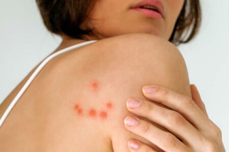 close-up of a woman’s shoulder showing a curved line of red, irritated bed bug bites.